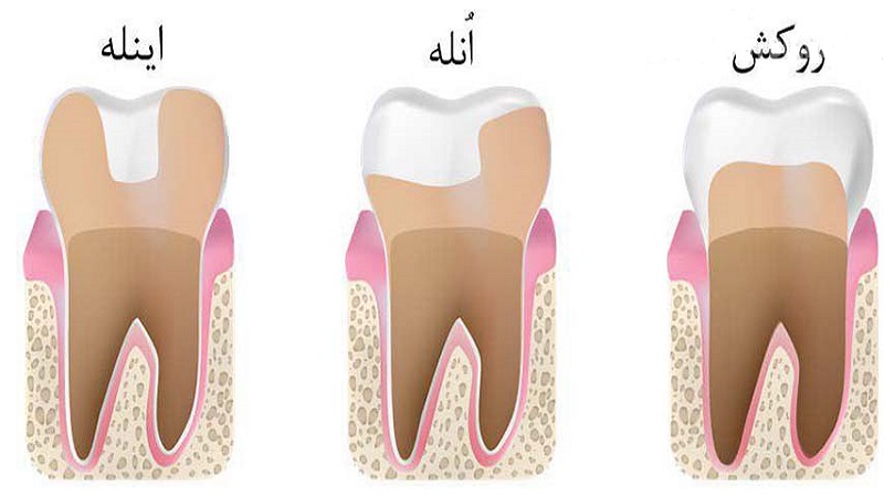 انله دندان چیست؟